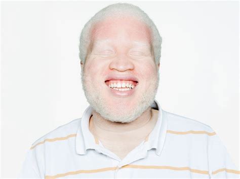 Albinism: Causes, Types, and Symptoms