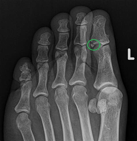 Distal Phalanx Fracture Big Toe