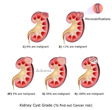 Don't Ignore Cysts, says Robotic Kidney Cancer Doctor - Cancerclinix