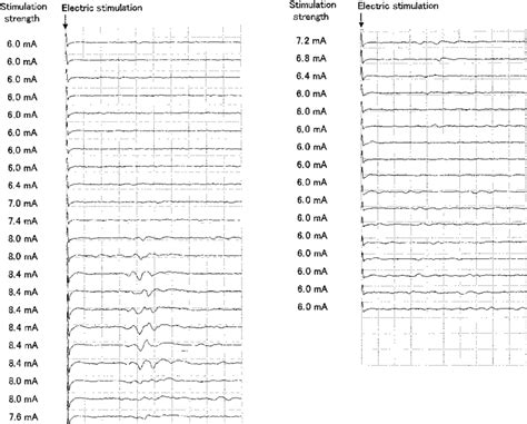 Evoked potential reaction of the bulbocavernosus reflex (BCR-EP) during... | Download Scientific ...