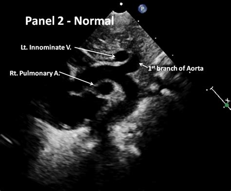 PediCardiology Quiz Answers: Quiz 19: Answer