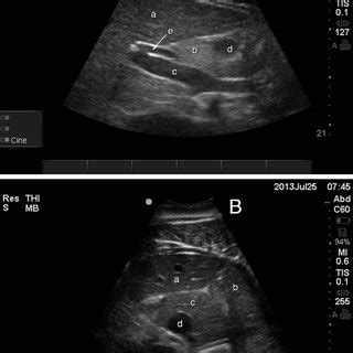 Longitudinal right-sided ultrasound image of the porta hepatis. The ...