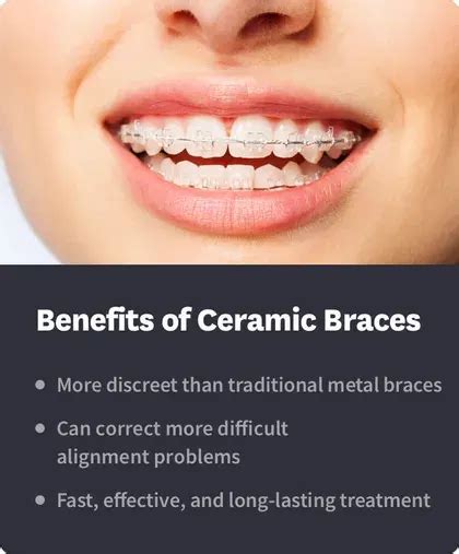 Ceramic Braces: Pros, Cons & Cost | Byte® | Byte®