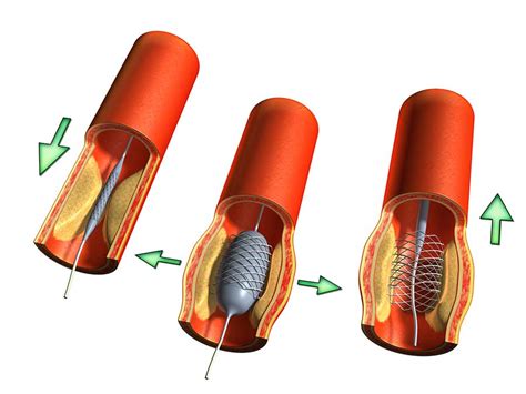 Stenting and surgery are equally efficient to treat strokes