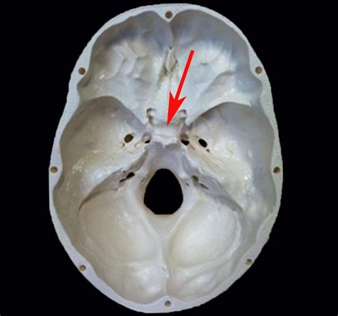 Sella turcica | Head and Neck Anatomy | Pinterest