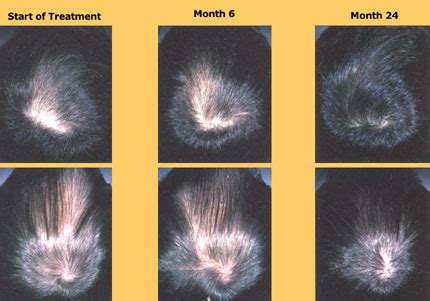 Finasteride Results Pictures