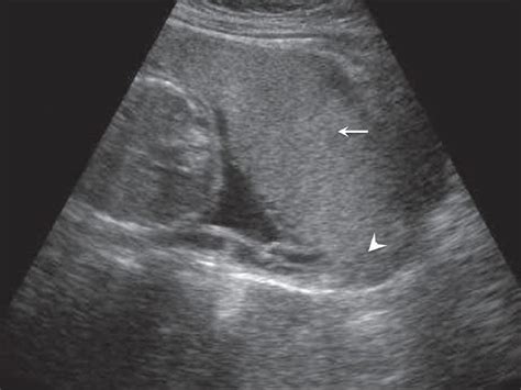 File:Placenta previa - anterior.jpg - Embryology