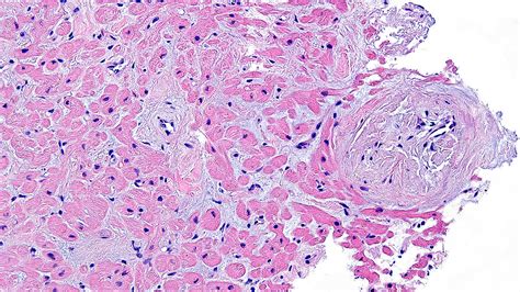 Heart Pathology*