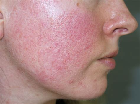 rosacea fulminans - pictures, photos