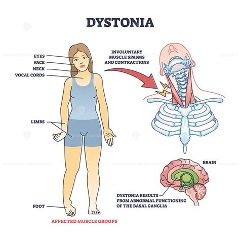 Dystonia disorder as abnormal muscle spasms and contractions outline ...