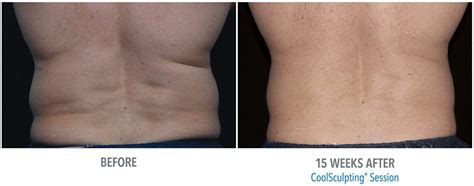 3 Things You Need to Know About CoolSculpting Side Effects | Dermacare HR