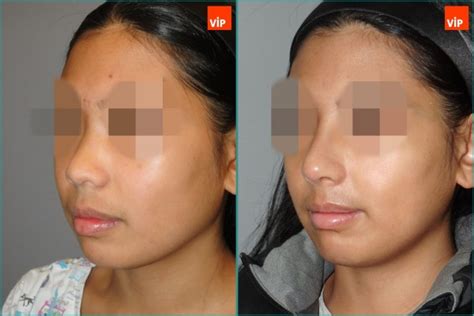 Rib cartilage rhinoplasty > Before & After Photo | VIP Plastic Surgery Korea