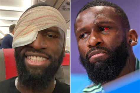 Antonio Rudiger shows off gruesome red eye and 20 stitches in head ...