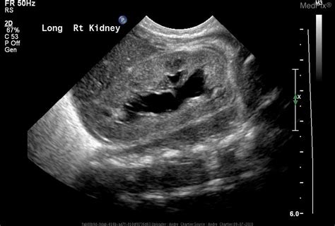 Trisomy 18 Ultrasound 13 Weeks