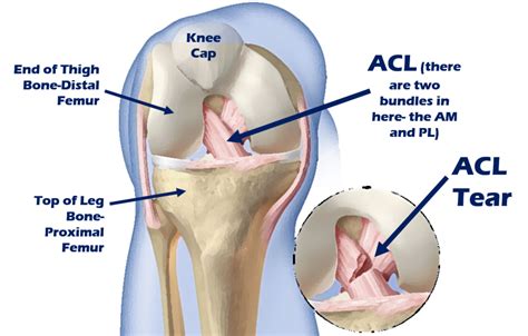 ACL Surgery Alternative? Meet the Perc-ACLR Procedure