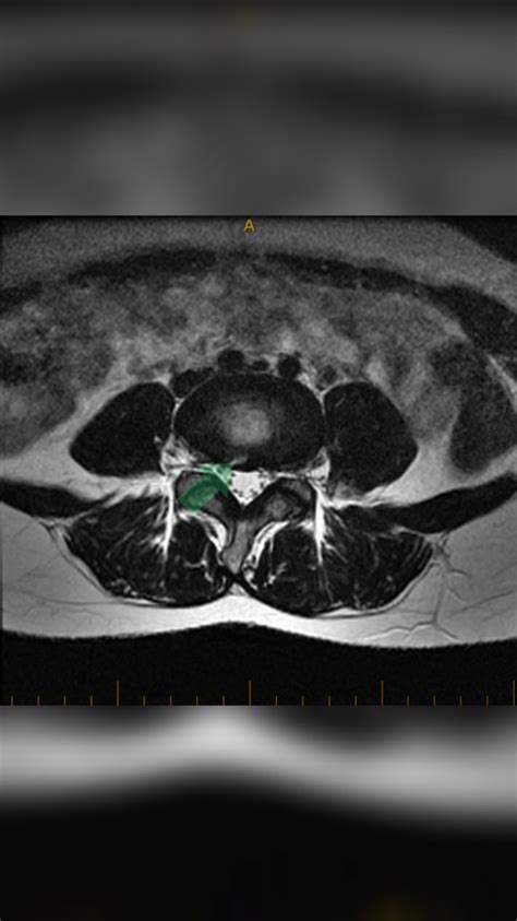 Annular Fissure | MRI findings with a Chronic Low Back Pain Patient ...