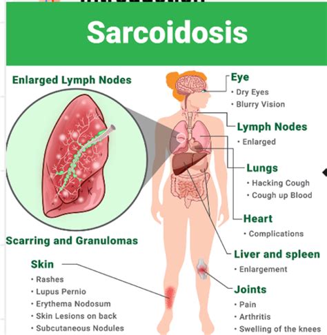 Sarcoidosis Flashcards | Quizlet