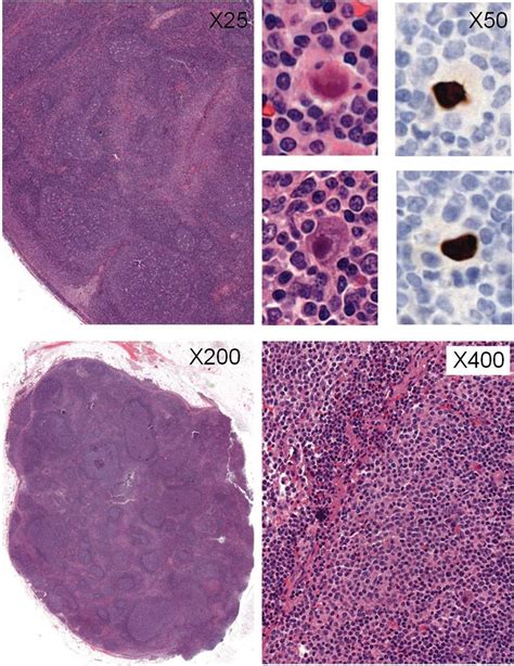 Lymph node biopsy. Histopathological analysis showed a reactive lymph ...