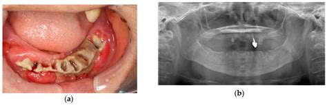 Osteonecrosis Of The Jaw Symptoms