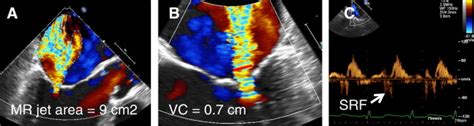 Transesophageal Echo (TEE) views showing severe mitral regurgitation ...