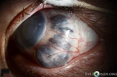 Scleromalacia and anterior staphyloma in the setting of congenital glaucoma: The University of ...