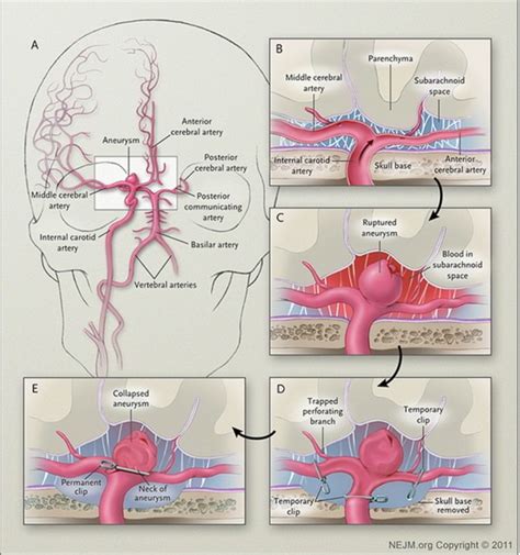 Subarachnoid Haemorrhage – Symptoms, Measures and Prognosis