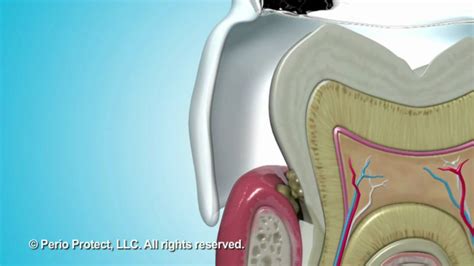 Perio Tray® by Perio Protect - Non-Invasive Treatment for Gum Disease - YouTube