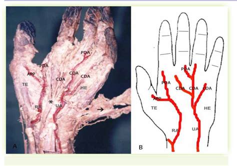 Figure 1 from The Incomplete Superficial Palmar Arch | Semantic Scholar