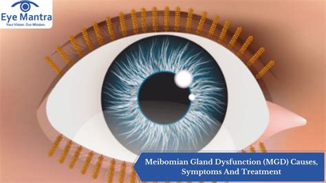 Meibomian Gland Dysfunction (MGD) Causes, Symptoms And Treatment