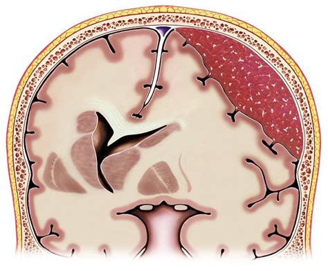 Subdural hematoma Guide: Causes, Symptoms and Treatment Options