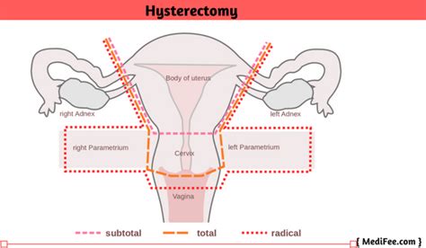 Uterus Removal Surgery - Hysterectomy Full Procedure, Risks and Complications