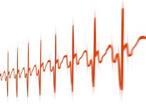 What You Should Know About Ambulatory ECG Monitoring