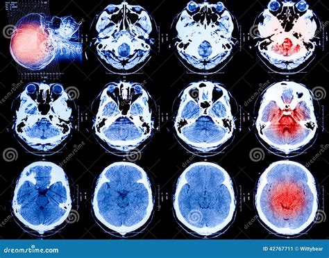 X-Ray scan human for brain stock image. Image of disease - 42767711