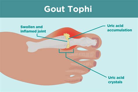 What Are Gout Tophi? Causes, Symptoms, and Treatments