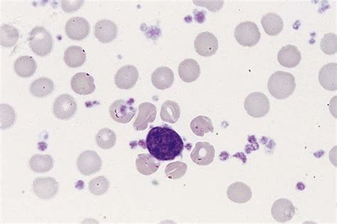 Myeloproliferative Neoplasms | Clinical Gate