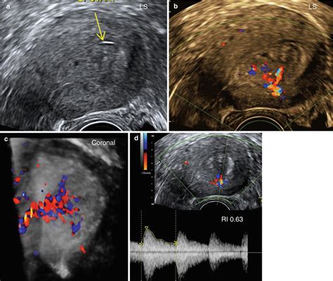 Ultrasound Evaluation of Endometrium | Obgyn Key