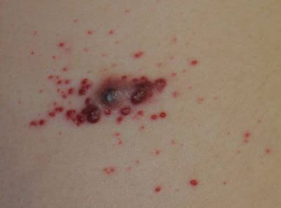 Erythematous Friable Papules on the Flank | MDedge Dermatology