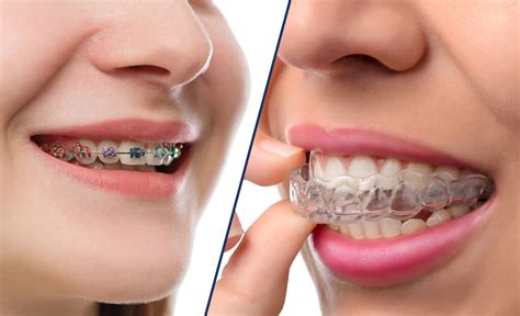 Disfruta de Invisalign y sus múltiples ventajas | Clínica Dental Cuadrado