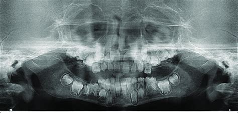 Orthopantomograph of the patient. | Download Scientific Diagram
