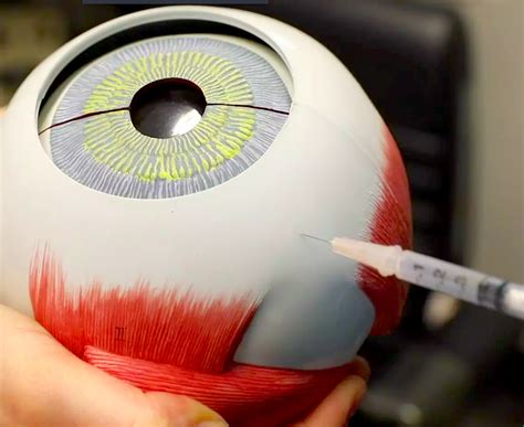 Eye Injections 101 » New York Eye Cancer Center