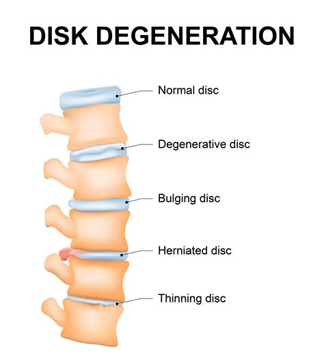 Degenerative Disc Disease of the Spine | Sierra Neurosurgery Group