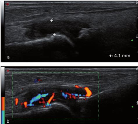 synovitis of the MTP joint 2 at dorsal aspect in grey scale ultrasound ...