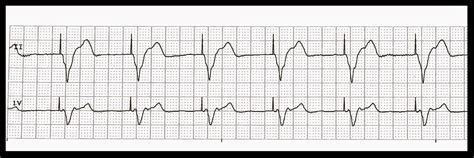 Practice EKG Strips 415