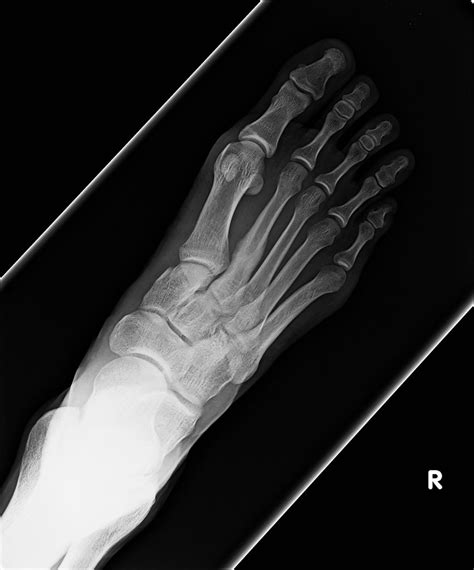 2nd metatarsal stress fracture top view | This is the x-ray … | Flickr