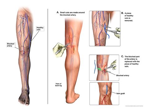 Peripheral Artery Disease - Treatment | NHLBI, NIH