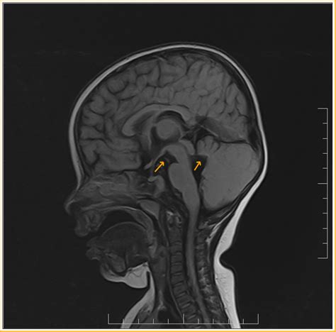 Joubert's Syndrome-MRI - Sumer's Radiology Blog