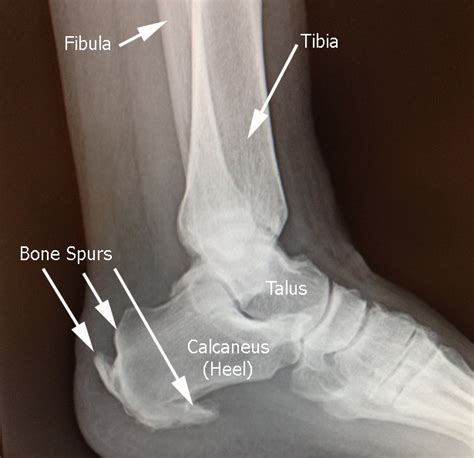 Achilles Tendonitis - Drwolgin