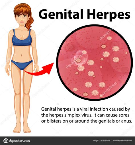 Genital Herpes Infographic Explanation Illustration Stock Vector by ...