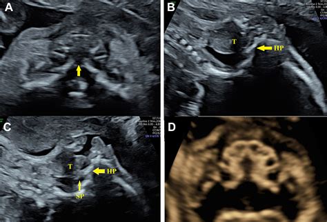 Cleft Lip And Palate 3d Ultrasound - Infoupdate.org