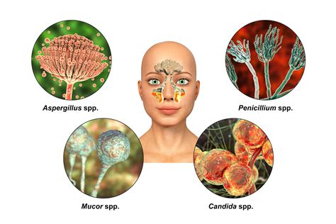 indossare biologico pupazzo di neve fungal infection symptoms in body Cestino Razza umana ...